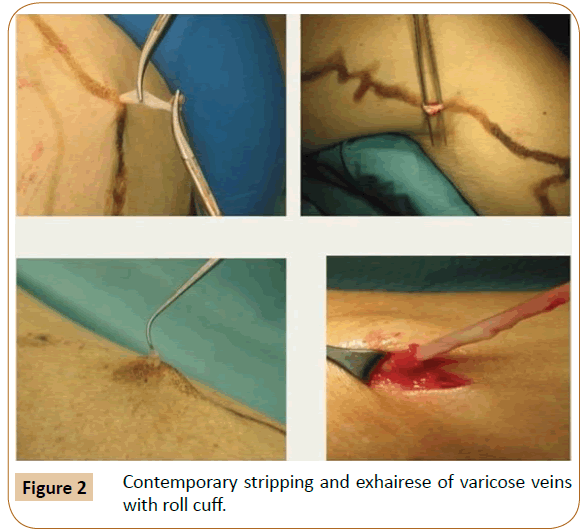 vascular-endovascular-therapy-Contemporary-stripping