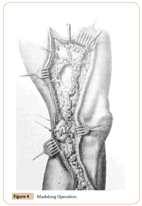 vascular-endovascular-therapy-Madelung-Operation