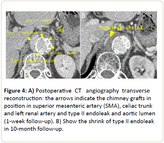 Endovascular-Surgery-Postoperative-CT-angiography-transverse