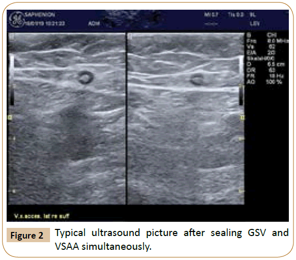 vascular-endovascular-Typical-ultrasound