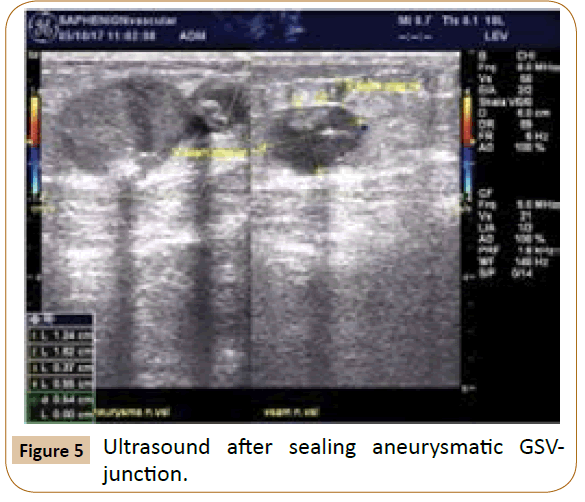 vascular-endovascular-sealing-aneurysmatic