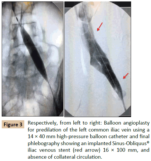 vascular-endovascular-surgery-Balloon-angioplasty