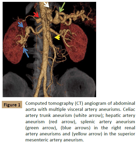 vascular-endovascular-surgery-Computed-tomography