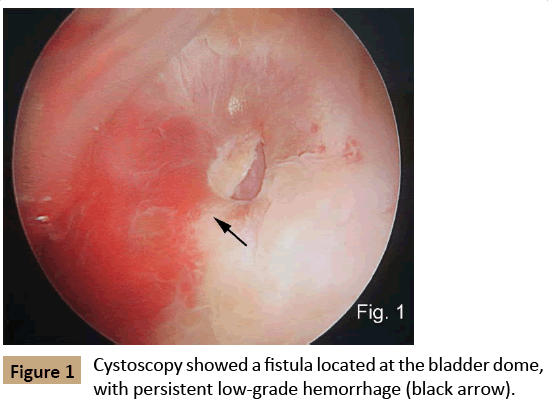 vascular-endovascular-surgery-Cystoscopy-showed-fistula-located