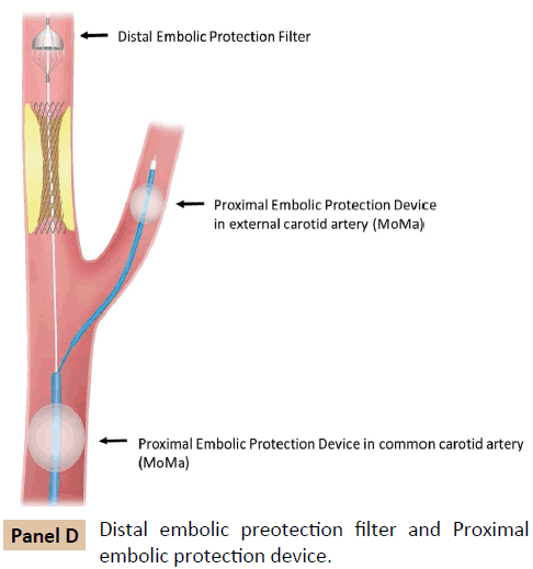 vascular-endovascular-surgery-Distal-embolic-preotection
