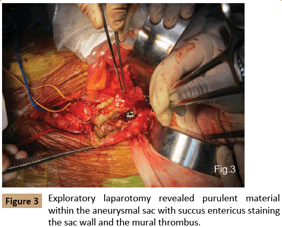 vascular-endovascular-surgery-Exploratory-laparotomy-revealed-purulent