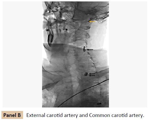 vascular-endovascular-surgery-External-carotid-artery