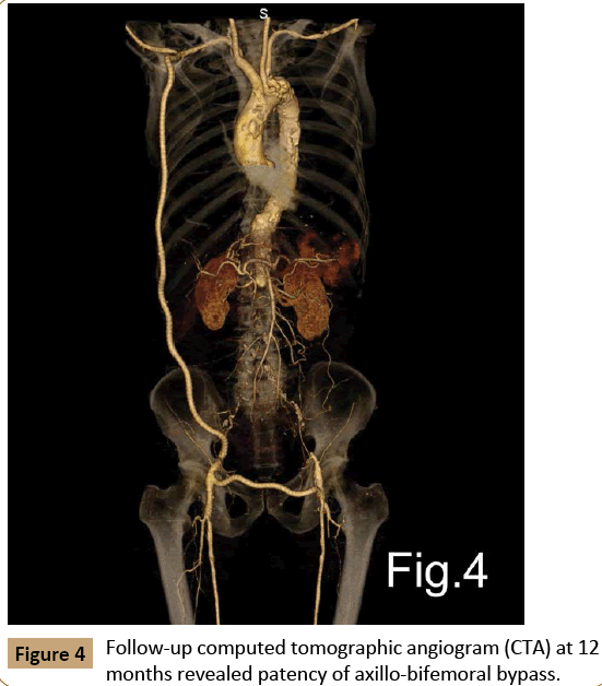 vascular-endovascular-surgery-Follow-up-computed-tomographic-angiogram