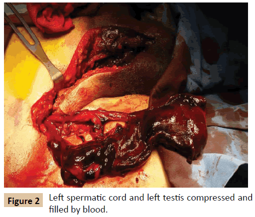 vascular-endovascular-surgery-Left-spermatic-cord