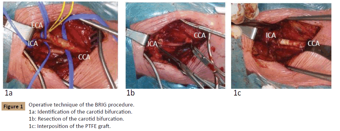 vascular-endovascular-surgery-Operative-technique