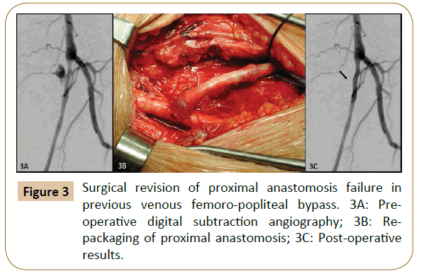 vascular-endovascular-surgery-Surgical-revision