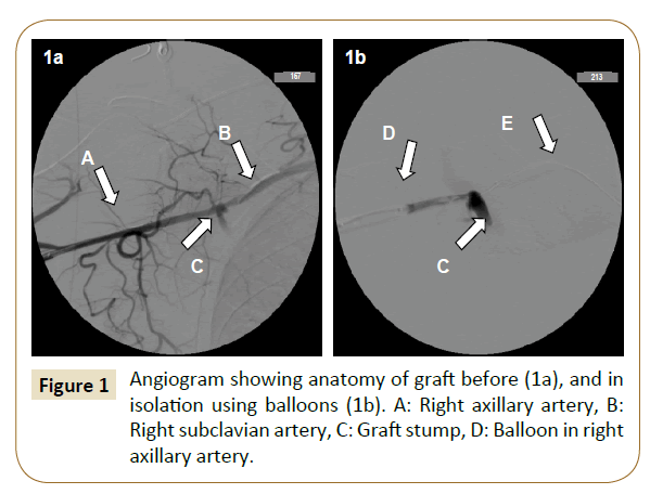 vascular-endovascular-surgery-axillary-artery