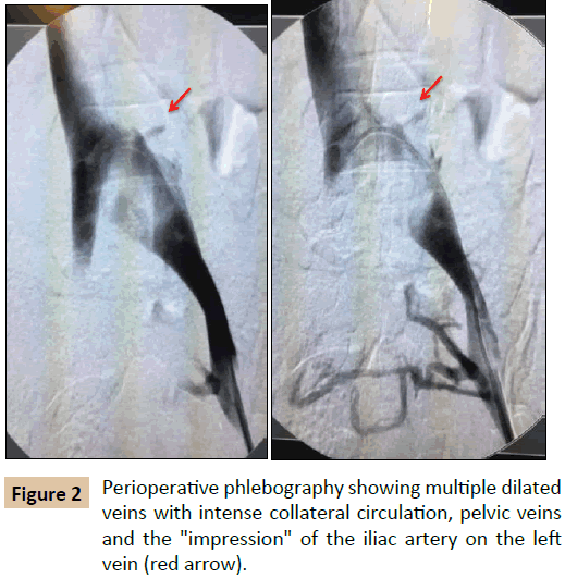 vascular-endovascular-surgery-collateral-circulation
