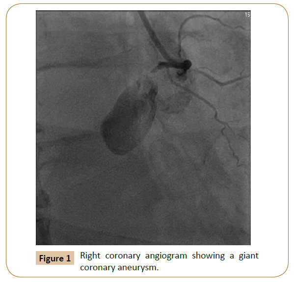 vascular-endovascular-surgery-coronary-aneurysm