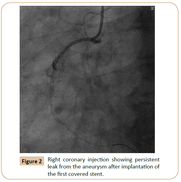 vascular-endovascular-surgery-covered-stent