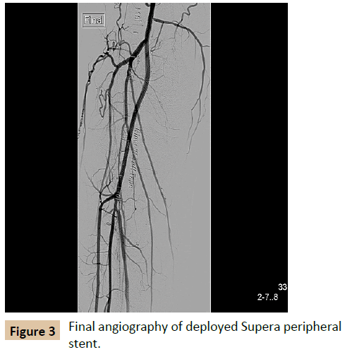 vascular-endovascular-surgery-deployed-Supera-peripheral