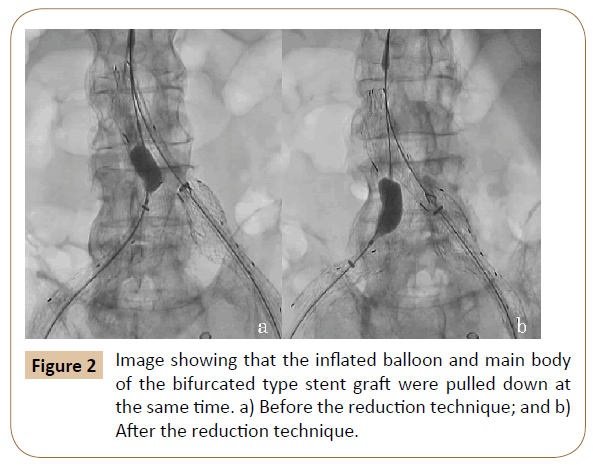 vascular-endovascular-surgery-inflated-balloon