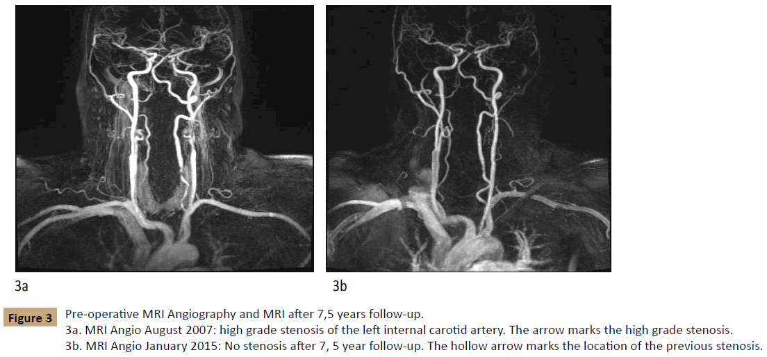 vascular-endovascular-surgery-left-internal-carotid