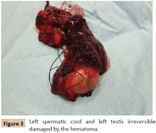 vascular-endovascular-surgery-left-testis-irreversible