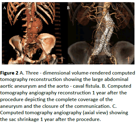 vascular-endovascular-surgery-volume-rendered-computed