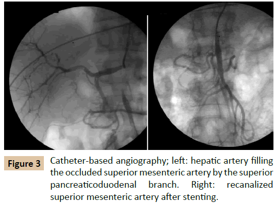 vascular-endovascular-therapy-Catheter-based-angiography