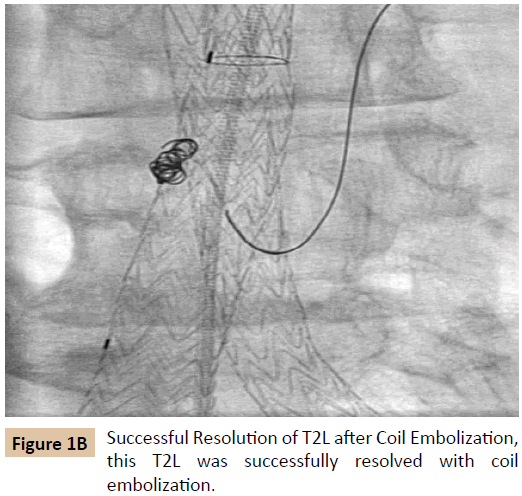 vascular-endovascular-therapy-Coil-Embolization