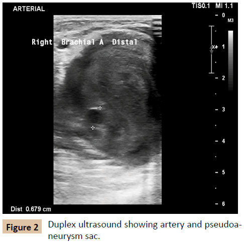 vascular-endovascular-therapy-Duplex-ultrasound