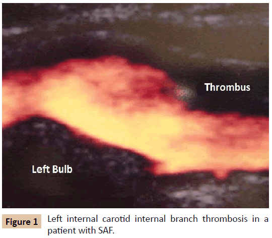 vascular-endovascular-therapy-Left-internal-carotid