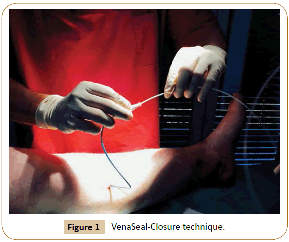 vascular-endovascular-therapy-VenaSeal-Closure