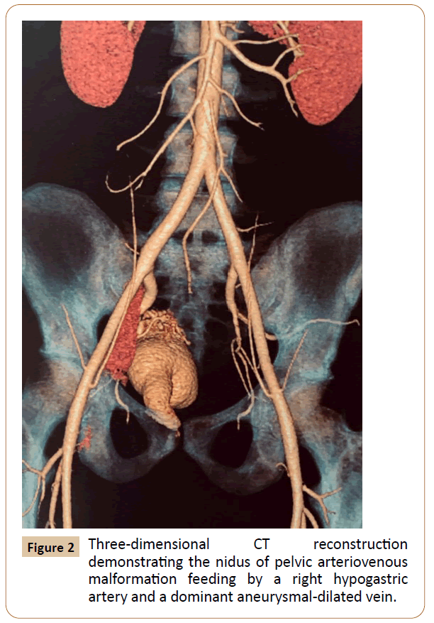 vascular-endovascular-therapy-artery