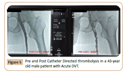 vascular-endovascular-therapy-catheter