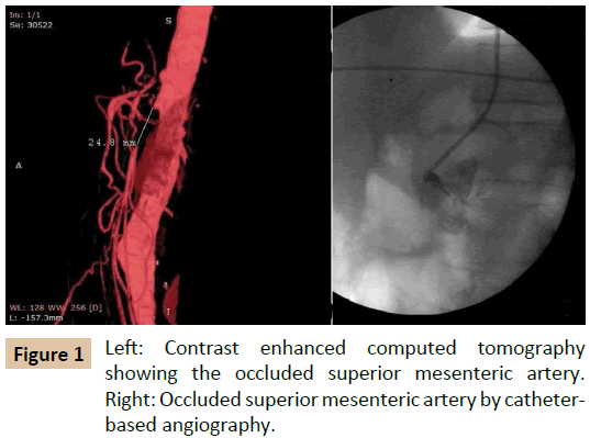 vascular-endovascular-therapy-enhanced-computed-tomography