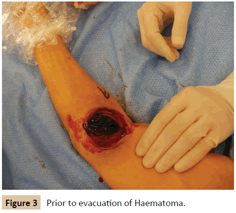 vascular-endovascular-therapy-evacuation-Haematoma