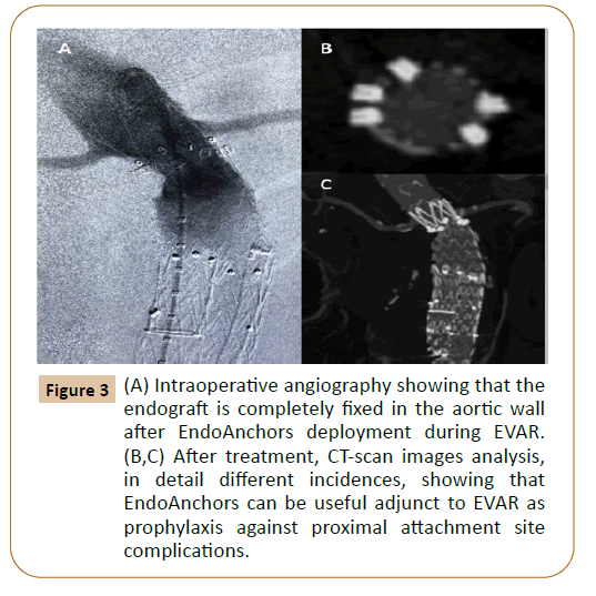 vascular-endovascular-therapy-incidences