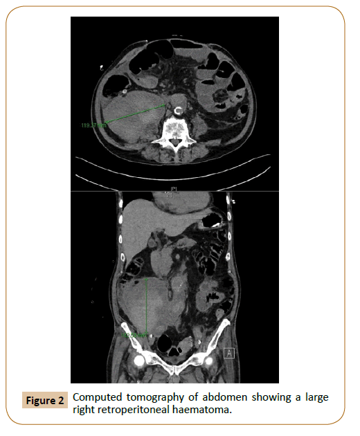 vascular-endovascular-therapy-retroperitoneal