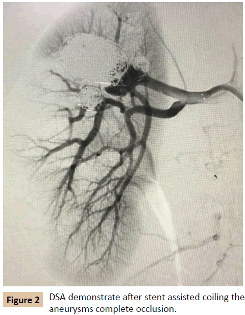 vascular-endovascular-therapy-stent-assisted-coiling
