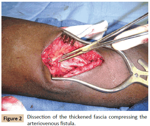 vascular-endovascular-therapy-thickened-fascia