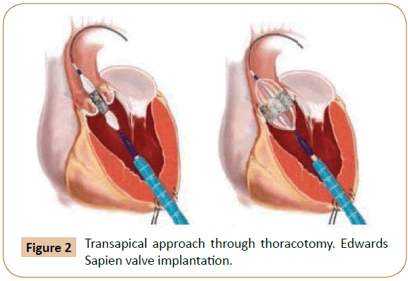 vascular-endovascular-therapy-thoracotomy