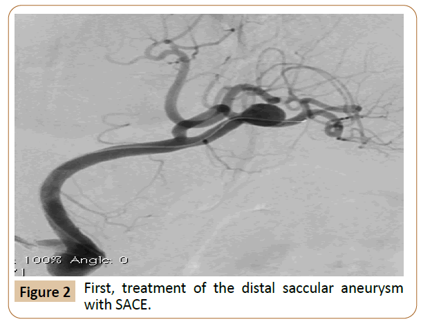 vascular-endovascular-therapy-treatment