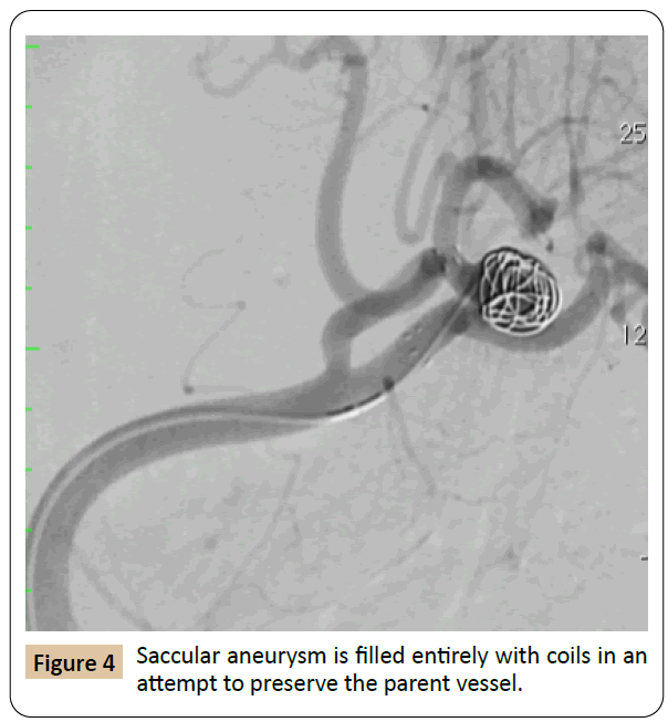 vascular-endovascular-therapy-vessel